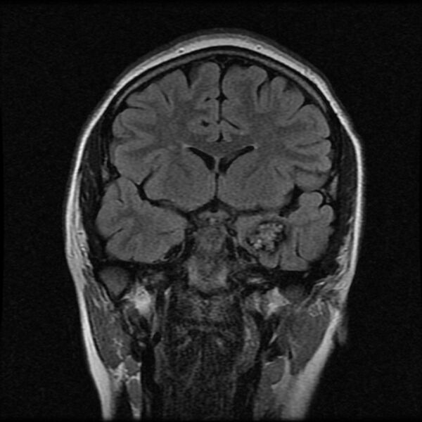 File:Cerebral cavernous malformation (Radiopaedia 44301-47942 Coronal FLAIR 7).jpg