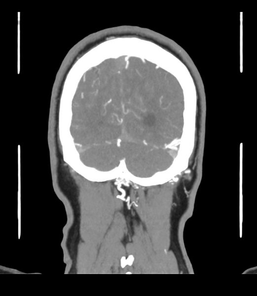 File:Cerebral dural venous sinus thrombosis (Radiopaedia 86514-102576 B 66).jpg