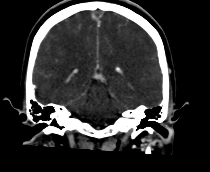 File:Cerebral venous sinus thrombosis (Radiopaedia 59224-66646 Coronal C+ delayed 48).jpg