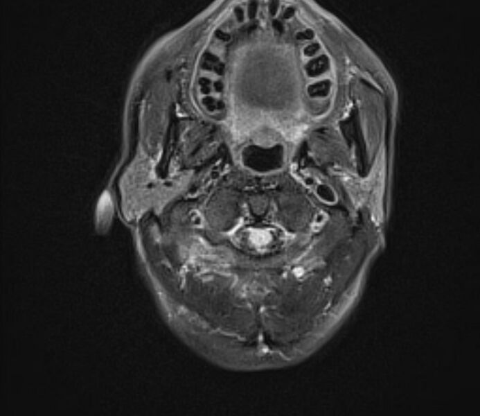 File:Cerebral venous thrombosis (Radiopaedia 71207-81504 Axial FLAIR 1).jpg