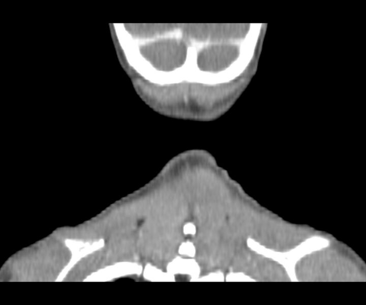 File:Cervical cystic lymphangioma (Radiopaedia 63655-72332 Coronal + contrast 33).jpg