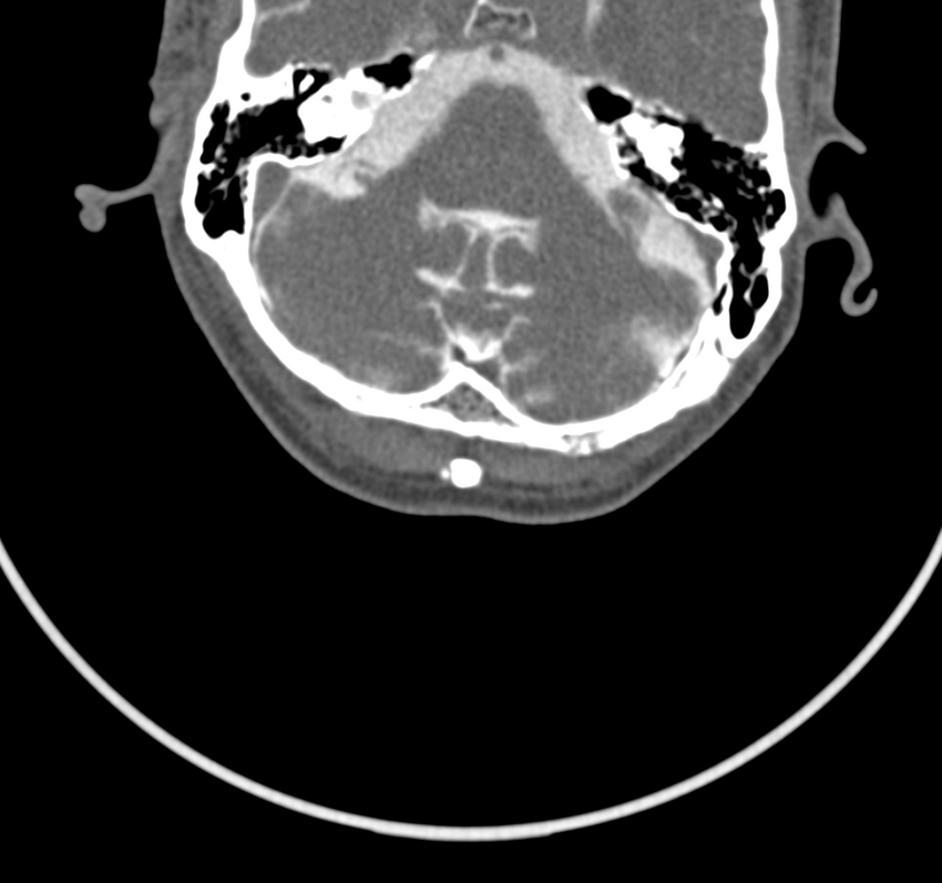 Cervical dural CSF leak on MRI and CT treated by blood patch (Radiopaedia 49748-54996 B 4).png