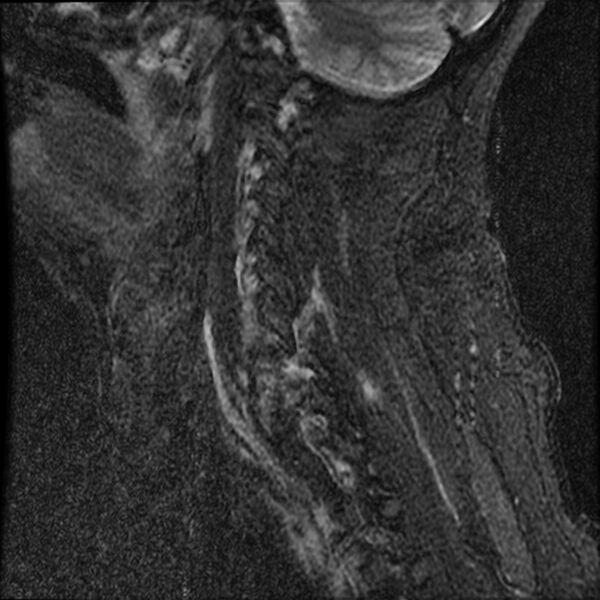 File:Cervical fracture and dislocation with locked facet (Radiopaedia 31837-32781 Sagittal STIR 15).jpg