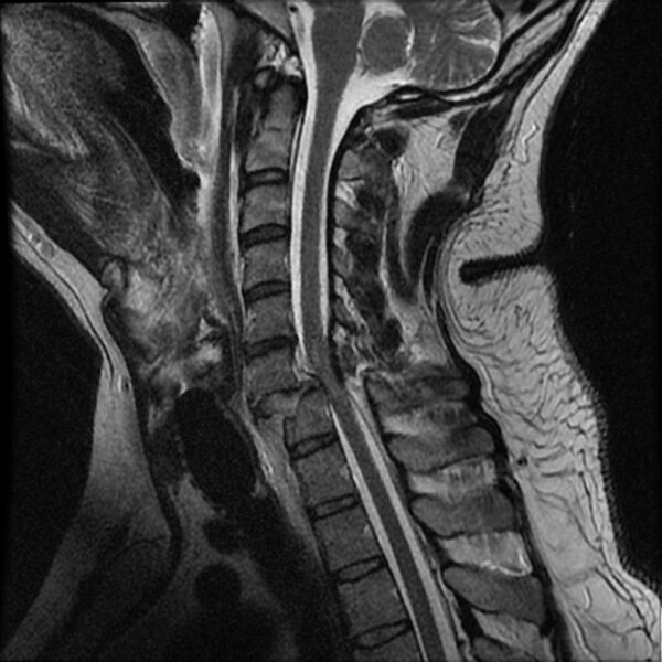 File:Cervical fracture and dislocation with locked facet (Radiopaedia 31837-32781 Sagittal T2 9).jpg
