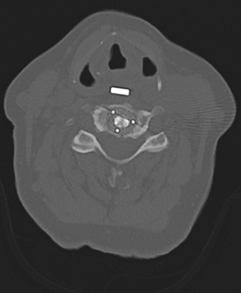 File:Cervical spine ACDF loosening (Radiopaedia 48998-54071 Axial bone window 32).png