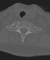 Cervical spine ACDF loosening (Radiopaedia 48998-54071 Axial bone window 48).png