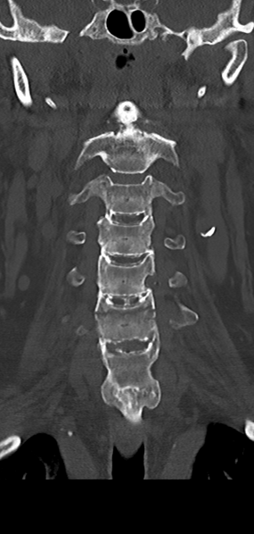 File:Cervical spine fracture - chalk stick (Radiopaedia 39116-41323 Coronal bone window 18).png