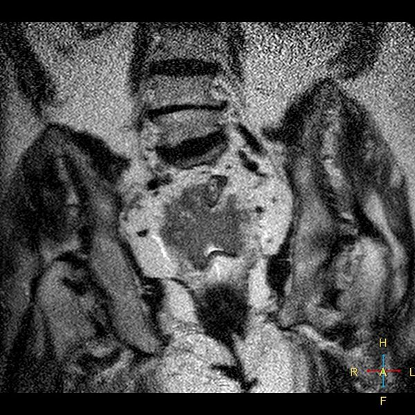 File:Cervical stump squamous cell carcinoma (Radiopaedia 48049-52858 Coronal T2 11).jpg
