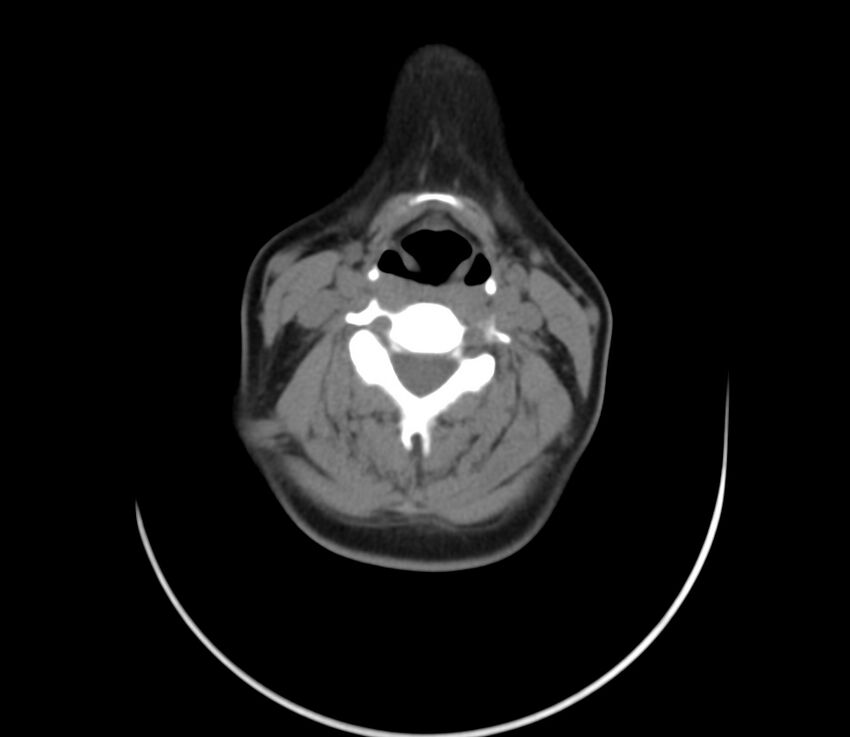 Cervical venous malformation (Radiopaedia 22653-22672 Axial non-contrast 33).jpg