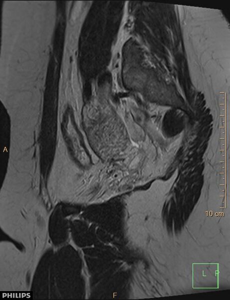 File:Cesarian scar endometriosis (Radiopaedia 68495-78066 Sagittal T2 22).jpg