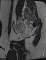 Cesarian scar endometriosis (Radiopaedia 68495-78066 Sagittal T2 22).jpg