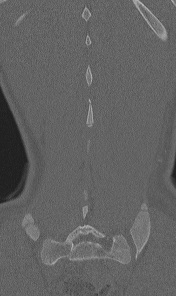File:Chance fracture (Radiopaedia 40360-42912 Coronal bone window 62).png