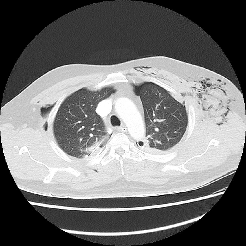Chest crush injury (Radiopaedia 31620-32513 Axial lung window 18).jpg