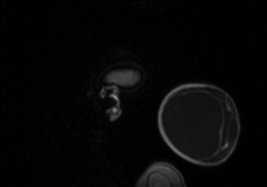 Chiari III malformation with occipital encephalocele (Radiopaedia 79446-92559 Sagittal T1 C+ mpr 10).jpg
