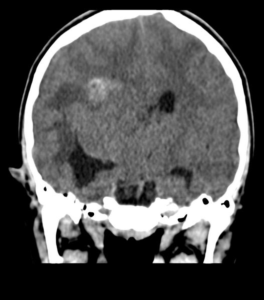 File:Choroid plexus carcinoma (Radiopaedia 91013-108552 Coronal non-contrast 44).jpg