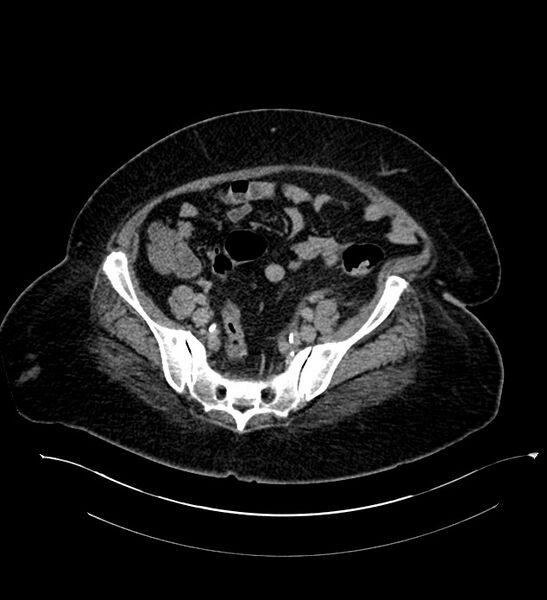 File:Chromophobe renal cell carcinoma (Radiopaedia 84239-99519 E 121).jpg