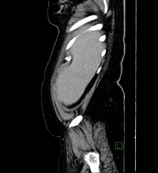 File:Chromophobe renal cell carcinoma (Radiopaedia 84239-99519 G 104).jpg
