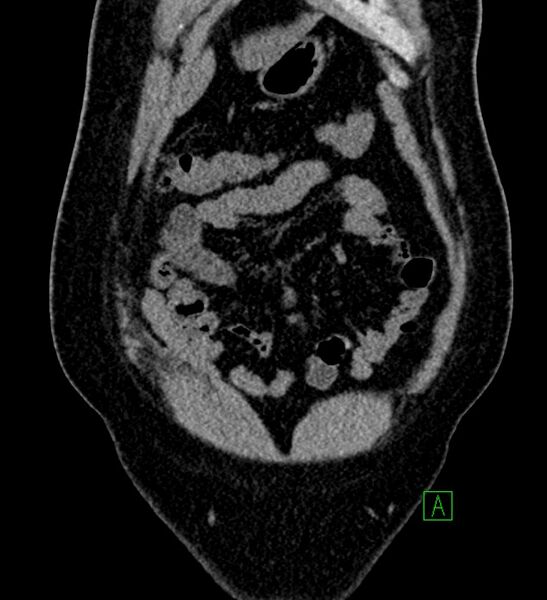 File:Chromophobe renal cell carcinoma (Radiopaedia 84286-99573 Coronal non-contrast 27).jpg