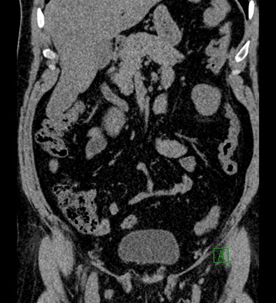 File:Chromophobe renal cell carcinoma (Radiopaedia 84286-99573 Coronal non-contrast 66).jpg