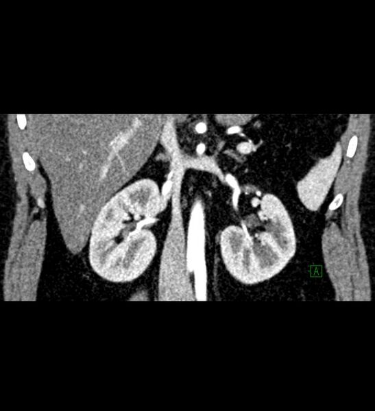 File:Chromophobe renal cell carcinoma (Radiopaedia 84286-99573 E 43).jpg