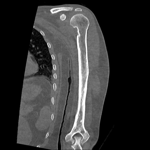 File:Chronic osteomyelitis (Radiopaedia 67597-76998 Coronal bone window 8).jpg