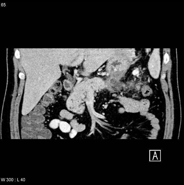 File:Chronic pancreatitis and pseudocysts (Radiopaedia 6724-7935 C 4).jpg