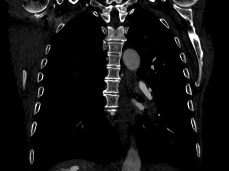 File:Chronic pulmonary embolism (Radiopaedia 91241-108843 A 73).jpg