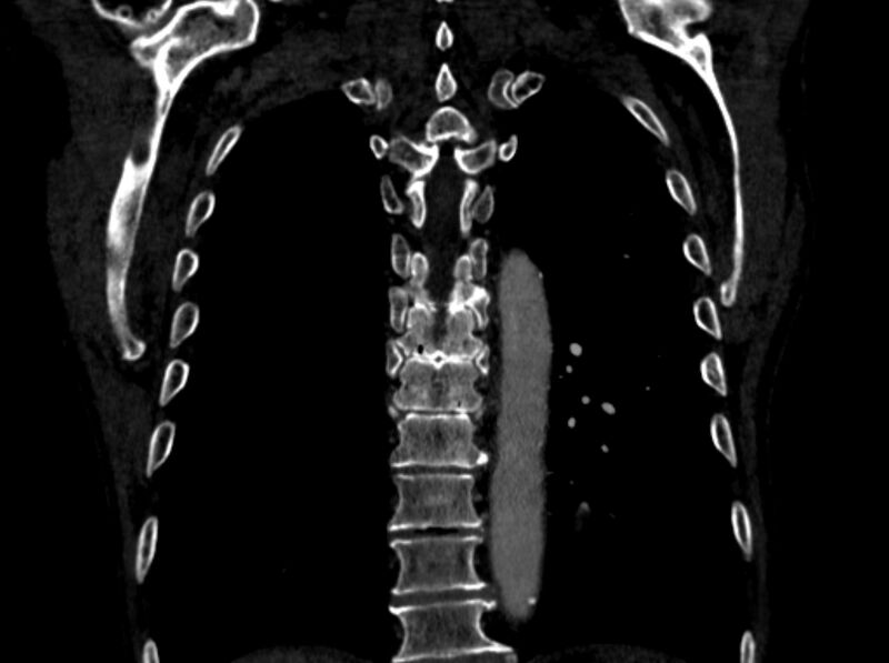 File:Chronic pulmonary embolism (Radiopaedia 91241-108843 A 88).jpg