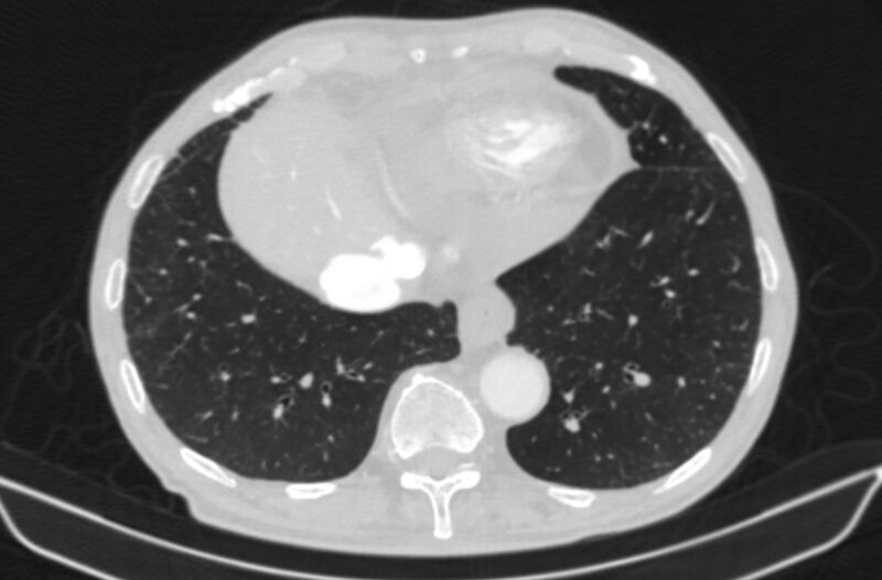 File:Chronic pulmonary embolism (Radiopaedia 91241-108843 Axial lung window 74).jpg