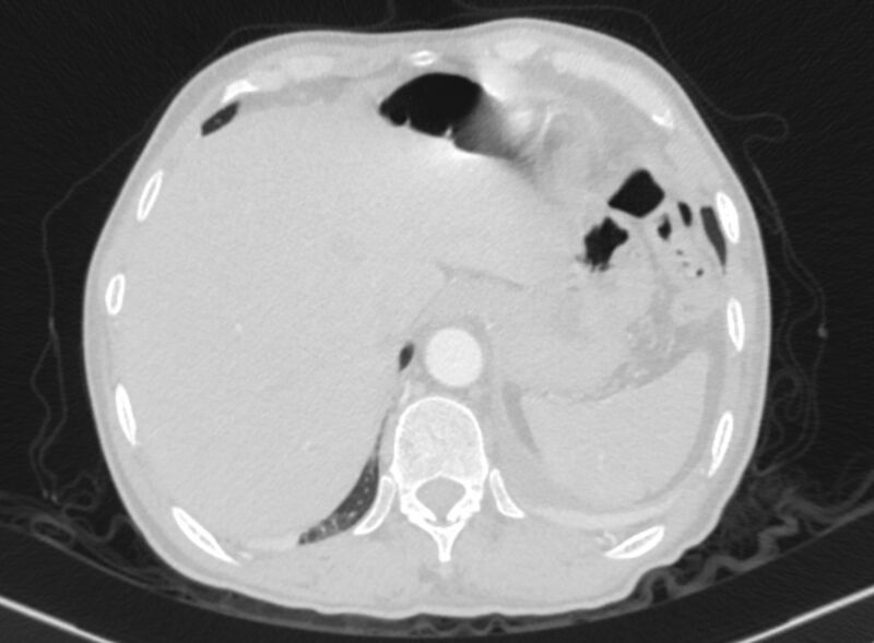 File:Chronic pulmonary embolism with bubbly consolidation (Radiopaedia 91248-108850 Axial lung window 138).jpg