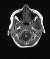 Chronic reactive multifocal osteomyelitis (CRMO) - mandible (Radiopaedia 56405-63069 Axial T1 18).jpg