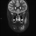 Chronic reactive multifocal osteomyelitis (CRMO) - mandible (Radiopaedia 56405-63069 Coronal STIR 13).jpg