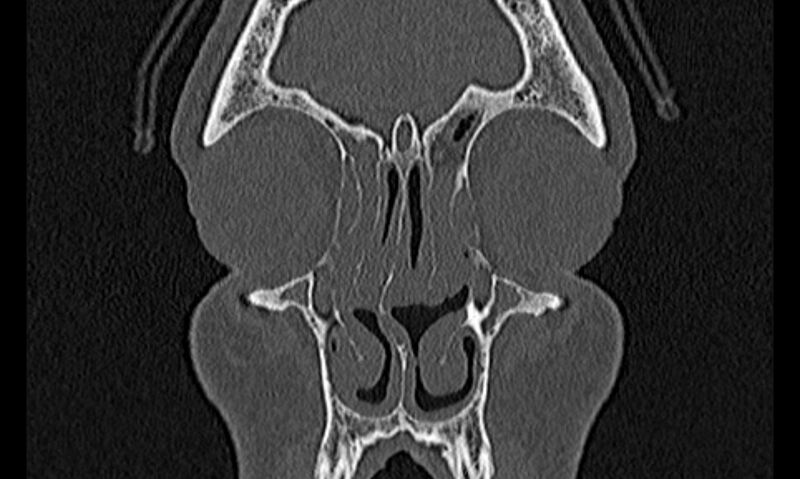 File:Chronic rhinosinusitis (Radiopaedia 65079-74075 Coronal bone window 17).jpg