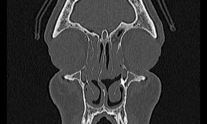 Chronic rhinosinusitis (Radiopaedia 65079-74075 Coronal bone window 17).jpg