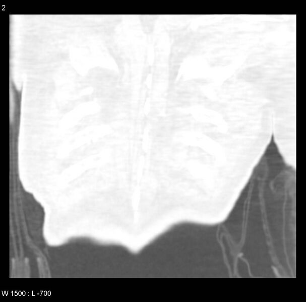 File:Clagett thoracotomy (Radiopaedia 8568-9403 Coronal lung window 2).jpg