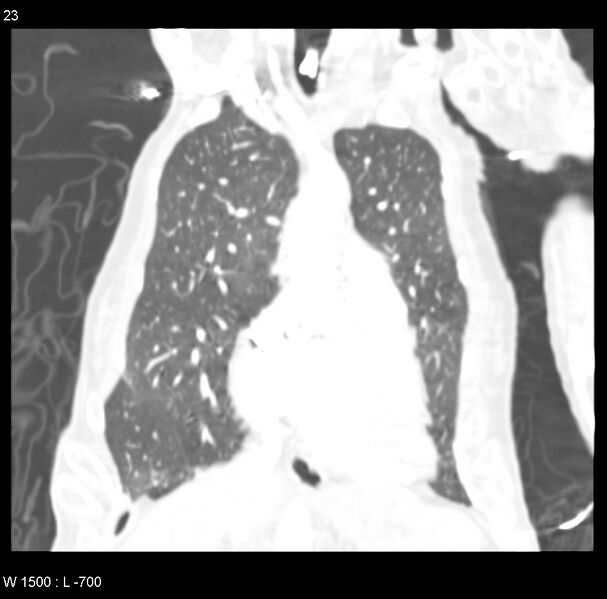 File:Clagett thoracotomy (Radiopaedia 8568-9403 Coronal lung window 23).jpg
