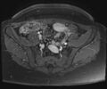 Class II Mullerian duct anomaly- unicornuate uterus with rudimentary horn and non-communicating cavity (Radiopaedia 39441-41755 Axial T1 fat sat 15).jpg