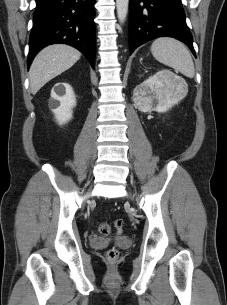File:Clear cell renal cell carcinoma (Radiopaedia 61449-69393 F 35).jpg