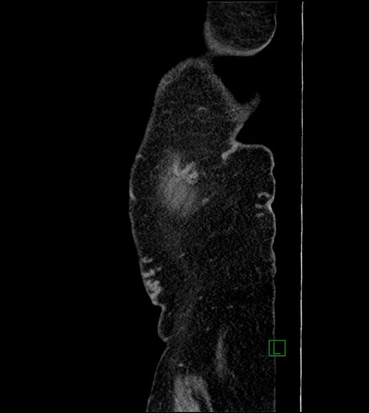 File:Closed-loop small bowel obstruction-internal hernia (Radiopaedia 78439-91096 C 138).jpg