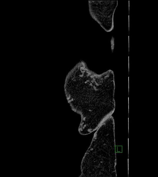File:Closed-loop small bowel obstruction-internal hernia (Radiopaedia 78439-91096 C 6).jpg