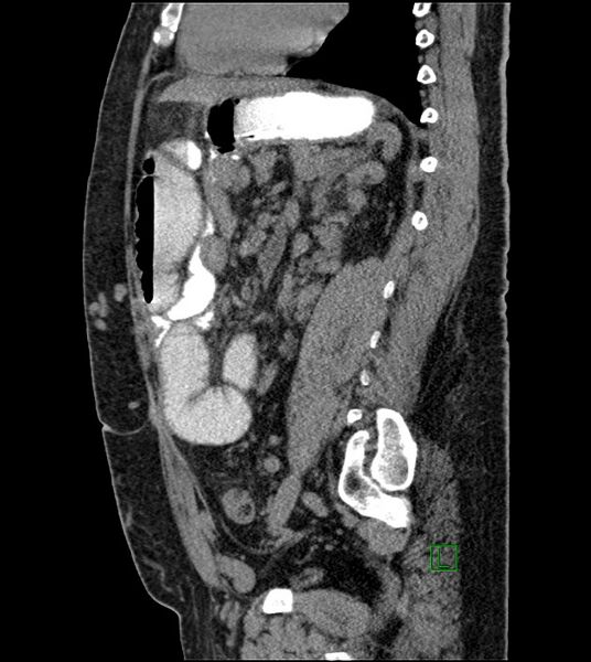 File:Closed-loop small bowel obstruction-internal hernia (Radiopaedia 78439-91096 C 63).jpg
