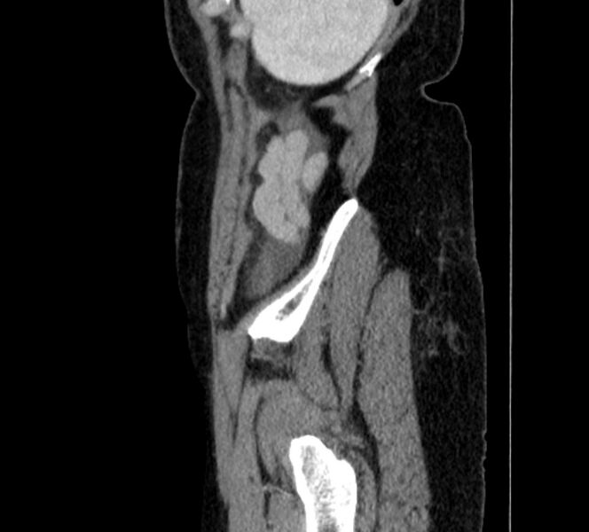 File:Closed loop small bowel obstruction (Radiopaedia 71211-81508 C 156).jpg