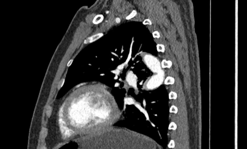 Coarctation of the aorta (Radiopaedia 53363-59343 B 47).jpg