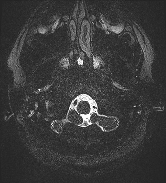 File:Cochlear incomplete partition type III associated with hypothalamic hamartoma (Radiopaedia 88756-105498 Axial T2 11).jpg