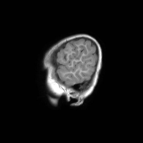 File:Cochlear nerve aplasia - unilateral (Radiopaedia 87910-104413 Sagittal T1 43).jpg