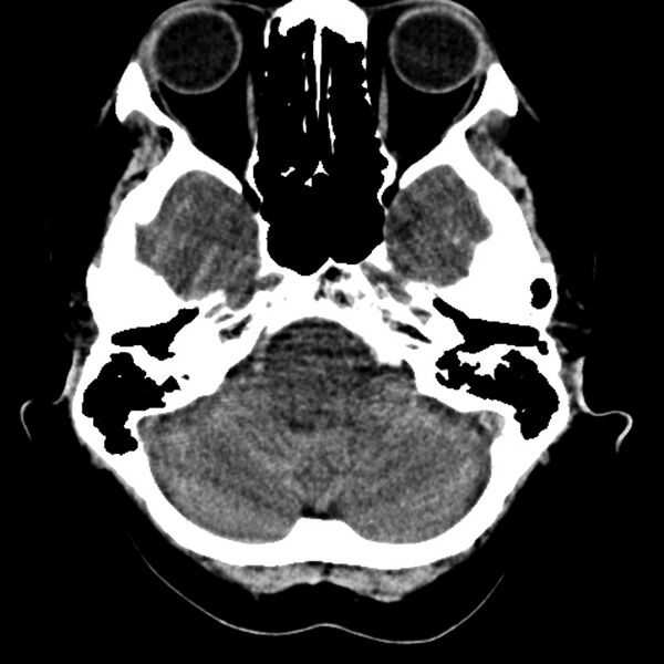 File:Colloid cyst with hydrocephalus (Radiopaedia 9373-10064 Axial non-contrast 4).jpg