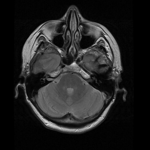 File:Colloid cyst with hydrocephalus (Radiopaedia 9373-10065 Axial PD 5).jpg
