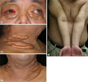 Erdheim-chester disease.png