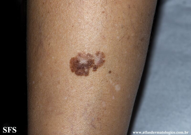 File:Melanoma (Dermatology Atlas 103).jpg