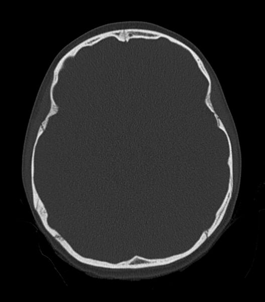 File:Nasoorbitoethmoid fracture (Radiopaedia 90044-107205 Axial bone window 98).jpg